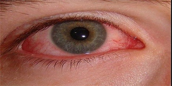 بیماری چشمی تراخم