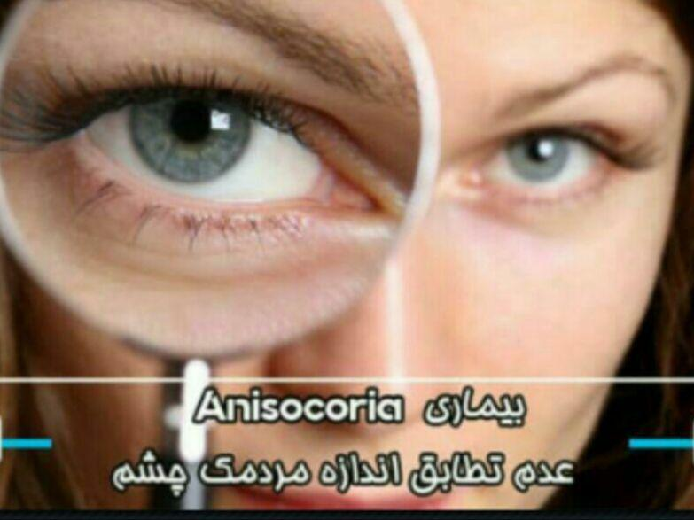 بیماری انیزوکوریا یا ناهمسانی اندازه‌ی مردمک چشم‌ها