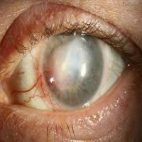 اندوفتالمیت یا (عفونت داخل چشمی)