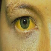 زردی چشم